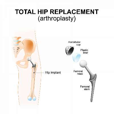 Let's Talk About Hip Replacement